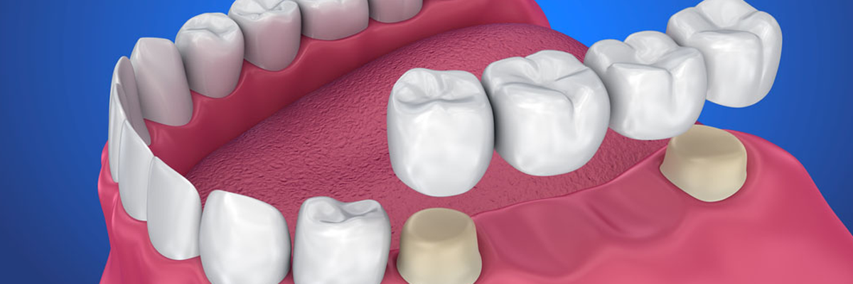 Dental Crowns and Bridges in Goregaon