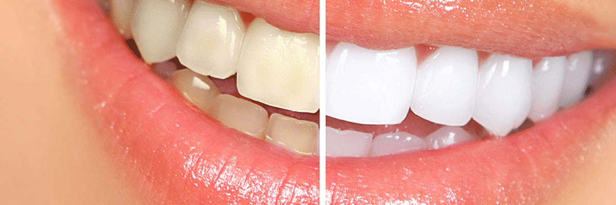 Teeth Whitening in Goregaon